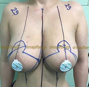 before-breast-lift-and-reduction-dr-arash-najaf-beygi